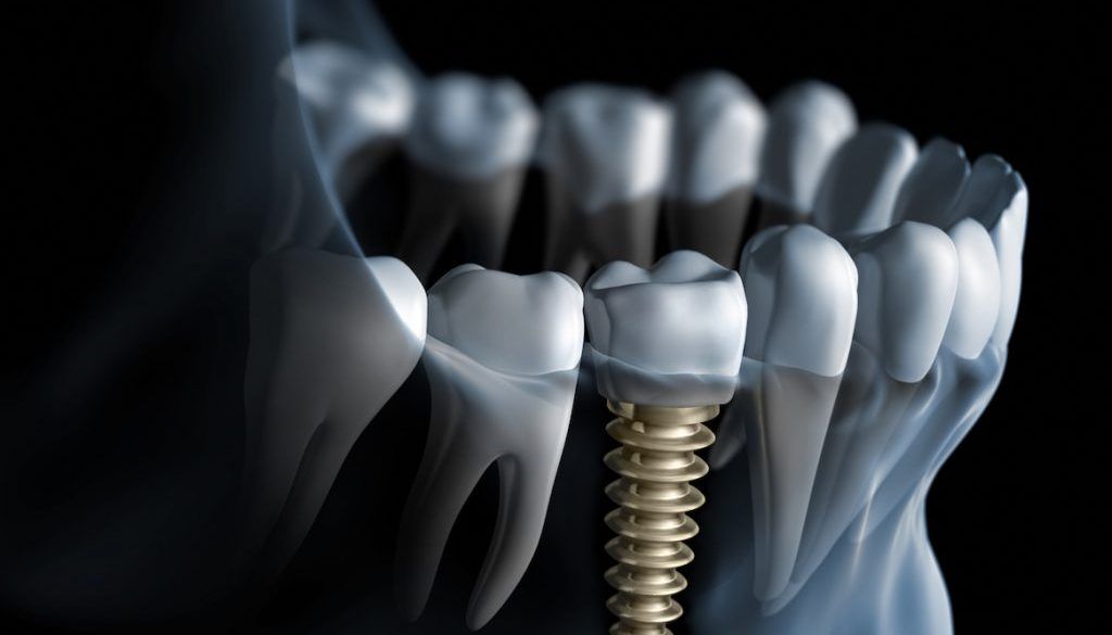Zęby trzecie, czyli kilka słów o implantach.