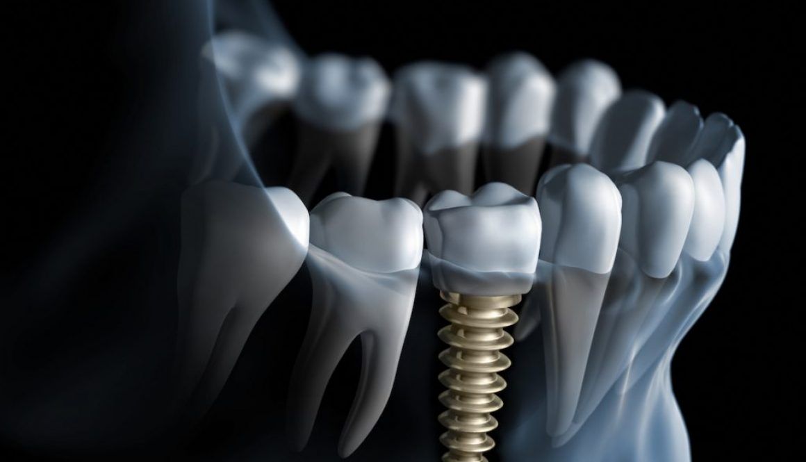 Zęby trzecie, czyli kilka słów o implantach.